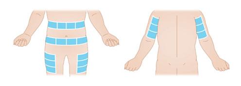 Subcutaneous Catheter devices insertion area